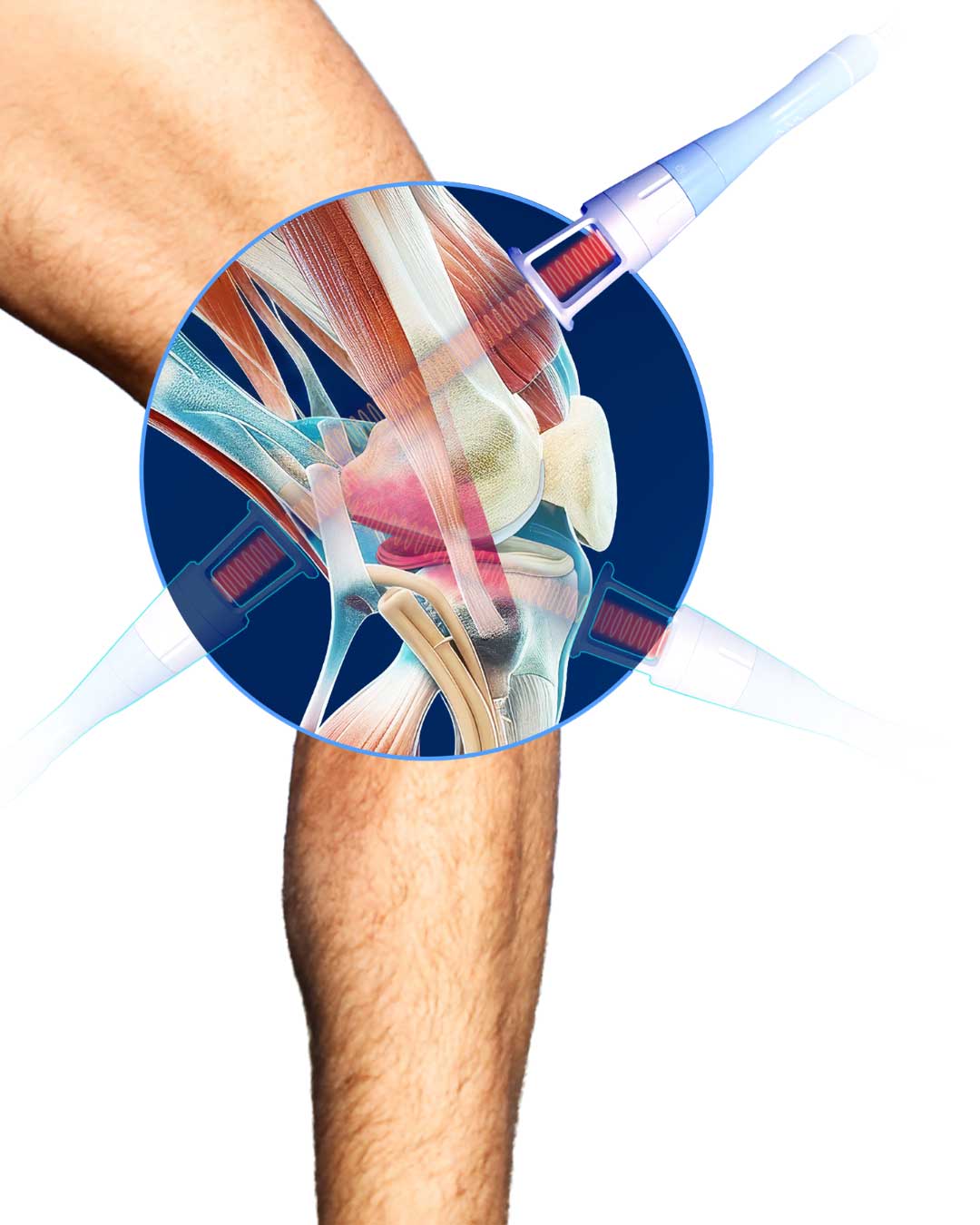 Illustration of laser therapy penetrating knee joint tissue, muscles and ligaments for knee pain treatment