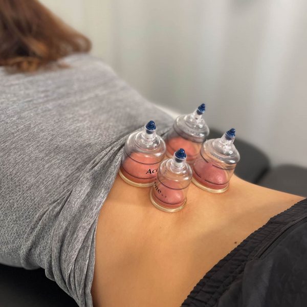 Cupping therapy for lower back pain relief at Santa Barbara wellness clinic